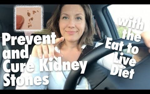 How to Prevent and Cure Kidney Stones with the Eat to Live Nutritarian Diet // + Lithotripsy Details